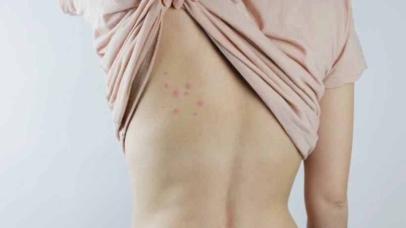 What Do Flea Bites Look Like? Unveiling the Tiny Culprits of Itchiness