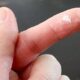 Tips for Removing Super Glue from Skin