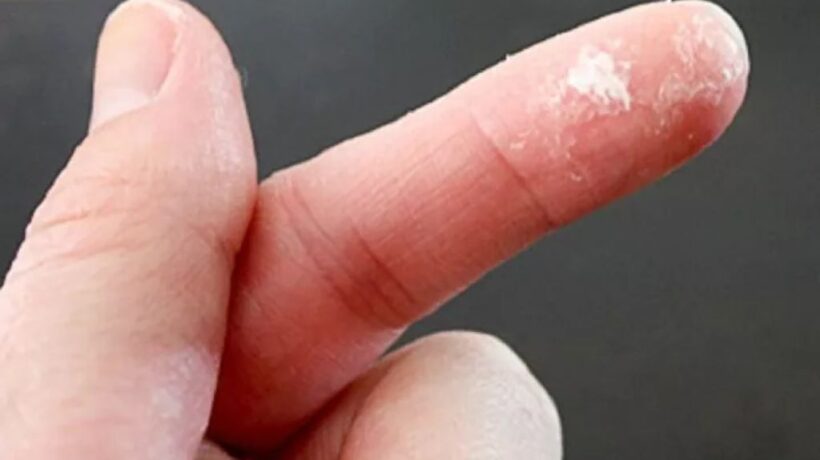 Effective Tips for Removing Super Glue from Skin