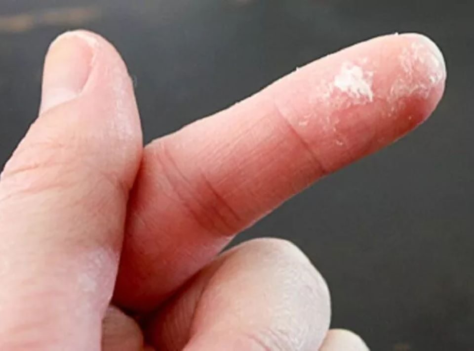 Tips for Removing Super Glue from Skin