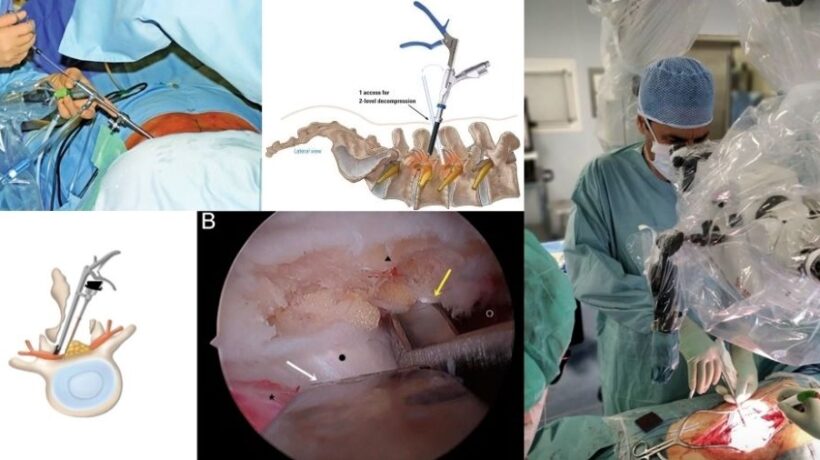 How Minimally Invasive Spine Surgery Can Speed Up Recovery
